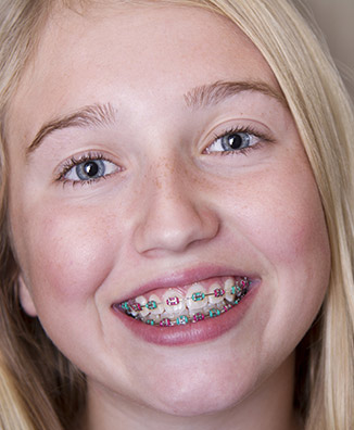 color my braces